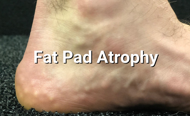 Fat Pad Atrophy