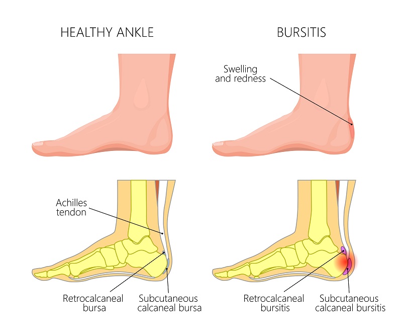 Achilles bursitis