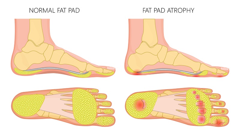 Foot fat pad atrophy