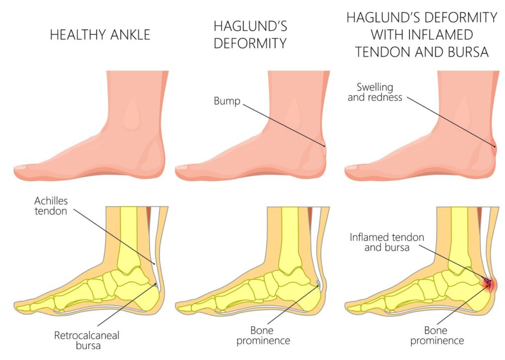 Haglund's Deformity