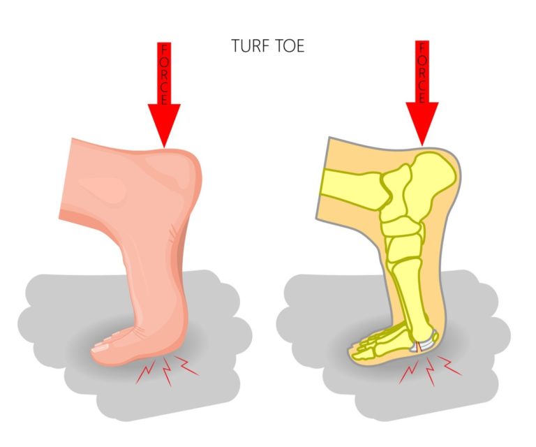 Turf Toe Plantar Fascia Institute of MN