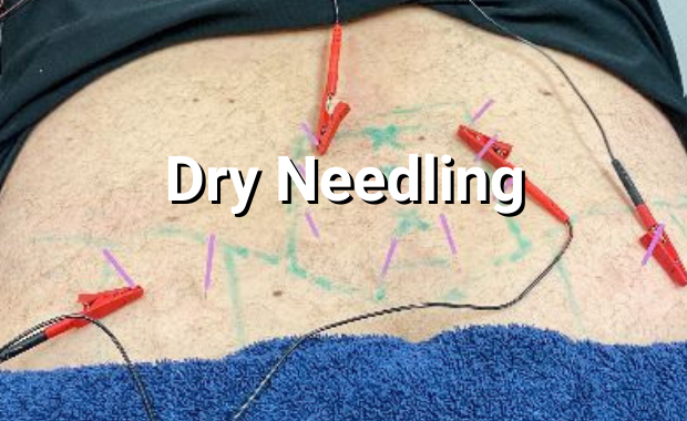 Dry Needling
